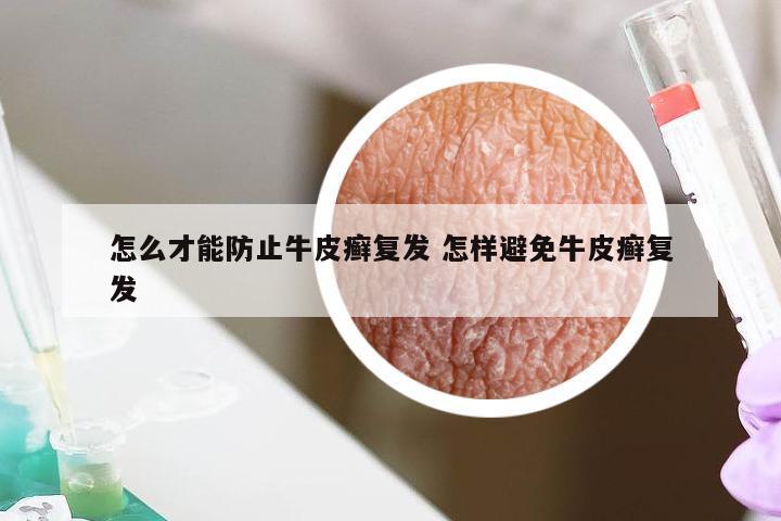 怎么才能防止牛皮癣复发 怎样避免牛皮癣复发