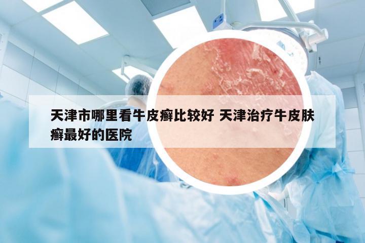 天津市哪里看牛皮癣比较好 天津治疗牛皮肤癣最好的医院