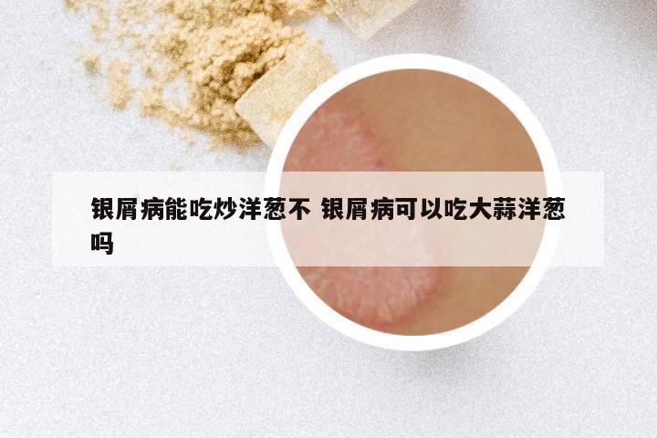 银屑病能吃炒洋葱不 银屑病可以吃大蒜洋葱吗