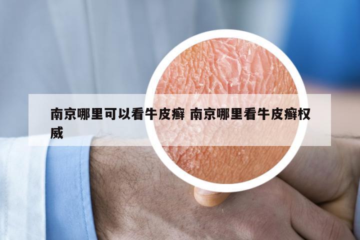南京哪里可以看牛皮癣 南京哪里看牛皮癣权威