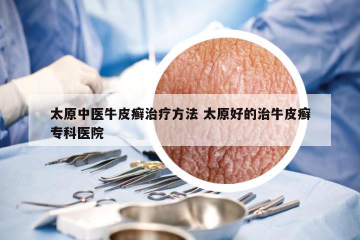 太原中医牛皮癣治疗方法 太原好的治牛皮癣专科医院