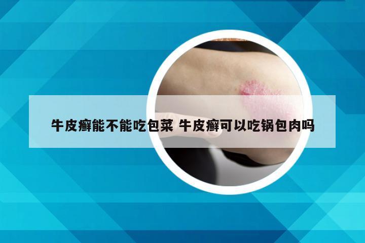 牛皮癣能不能吃包菜 牛皮癣可以吃锅包肉吗
