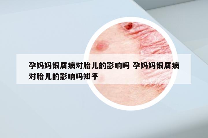 孕妈妈银屑病对胎儿的影响吗 孕妈妈银屑病对胎儿的影响吗知乎