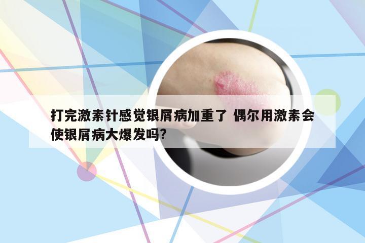 打完激素针感觉银屑病加重了 偶尔用激素会使银屑病大爆发吗?