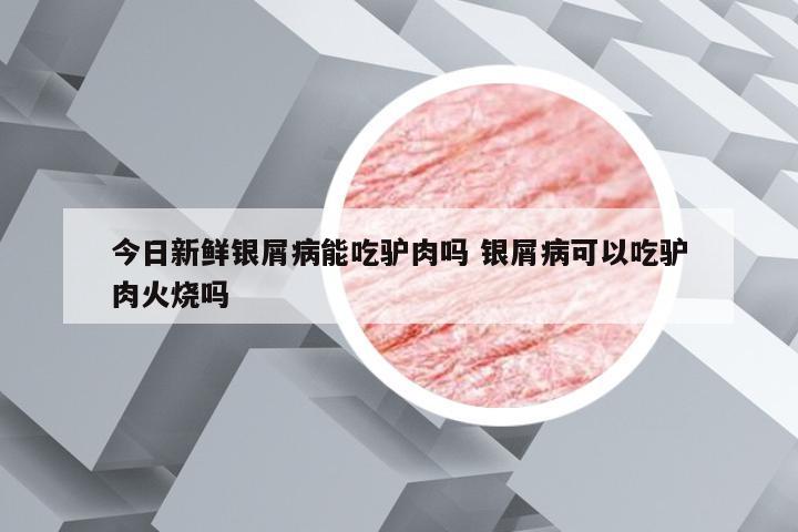 今日新鲜银屑病能吃驴肉吗 银屑病可以吃驴肉火烧吗