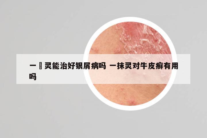一抺灵能治好银屑病吗 一抹灵对牛皮癣有用吗