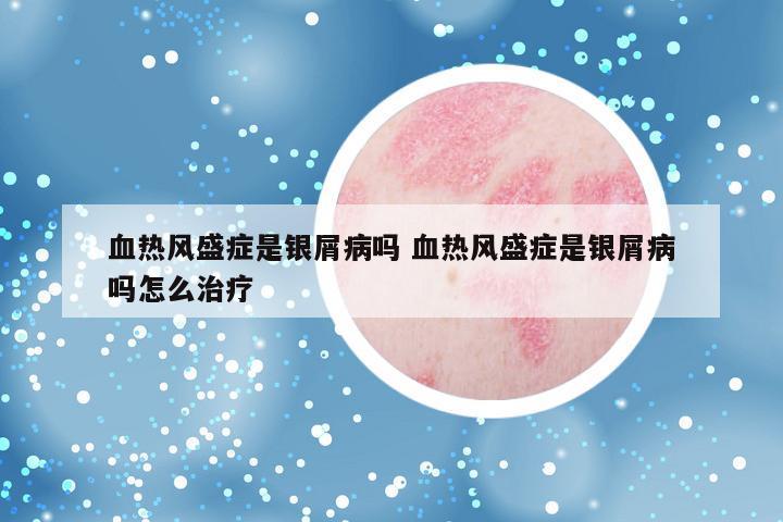 血热风盛症是银屑病吗 血热风盛症是银屑病吗怎么治疗