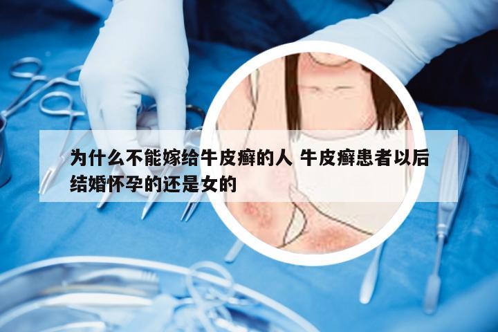 为什么不能嫁给牛皮癣的人 牛皮癣患者以后结婚怀孕的还是女的