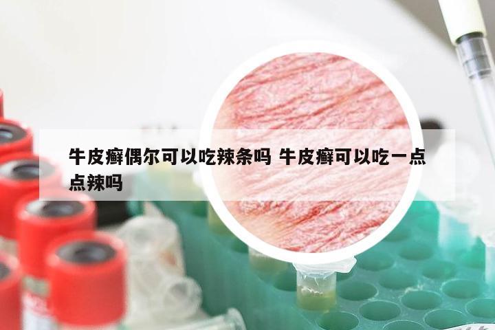 牛皮癣偶尔可以吃辣条吗 牛皮癣可以吃一点点辣吗