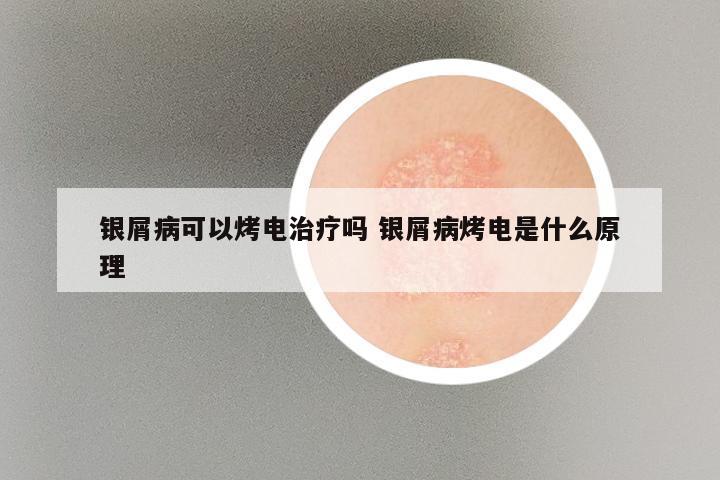 银屑病可以烤电治疗吗 银屑病烤电是什么原理