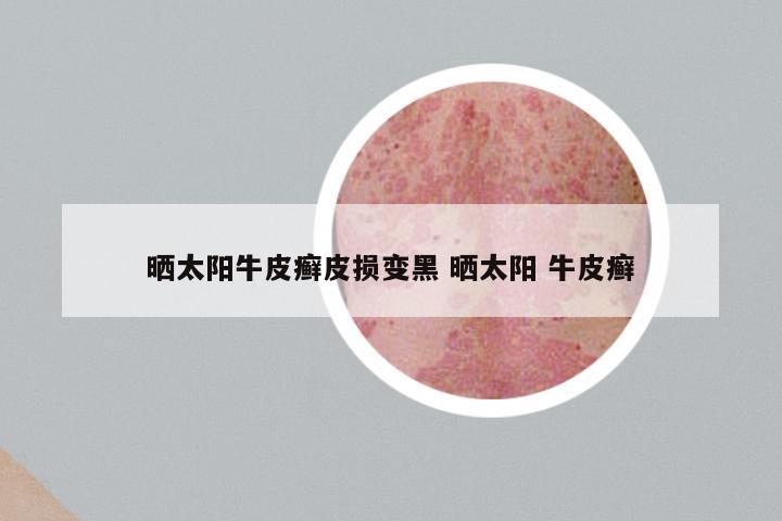 晒太阳牛皮癣皮损变黑 晒太阳 牛皮癣