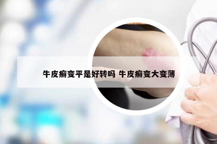 牛皮癣变平是好转吗 牛皮癣变大变薄