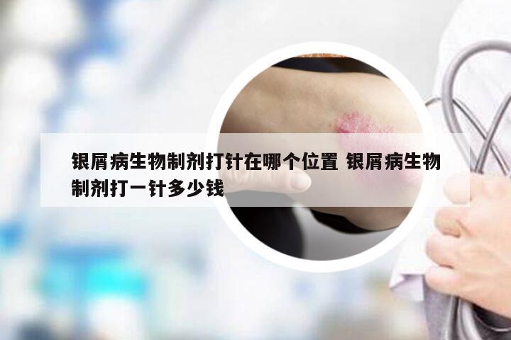 银屑病生物制剂打针在哪个位置 银屑病生物制剂打一针多少钱