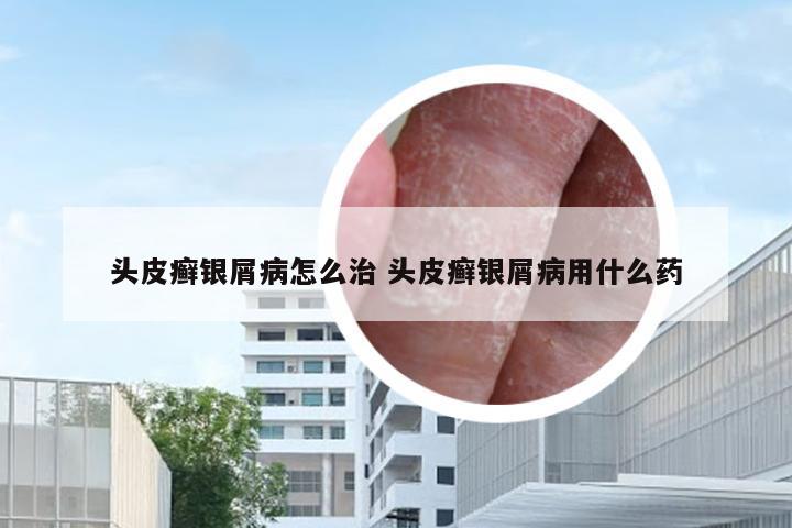 头皮癣银屑病怎么治 头皮癣银屑病用什么药