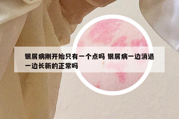 银屑病刚开始只有一个点吗 银屑病一边消退一边长新的正常吗