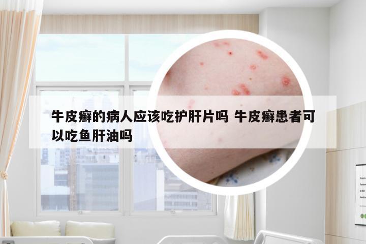 牛皮癣的病人应该吃护肝片吗 牛皮癣患者可以吃鱼肝油吗