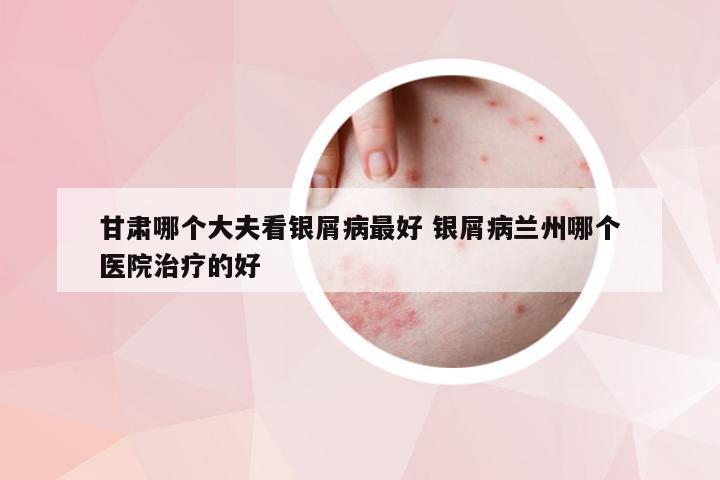 甘肃哪个大夫看银屑病最好 银屑病兰州哪个医院治疗的好