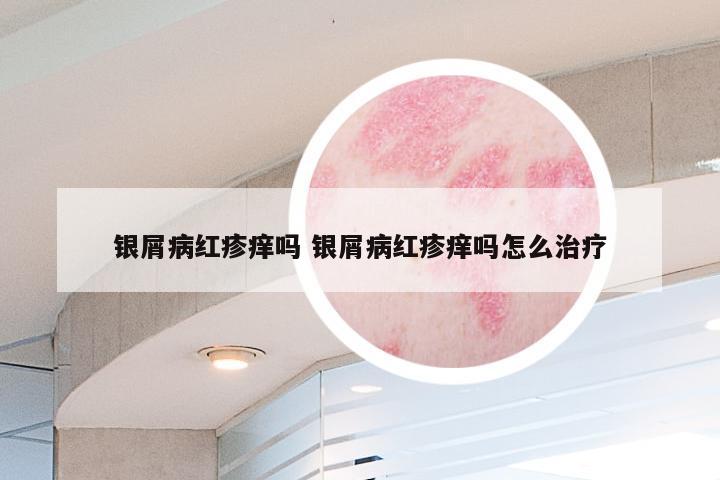 银屑病红疹痒吗 银屑病红疹痒吗怎么治疗