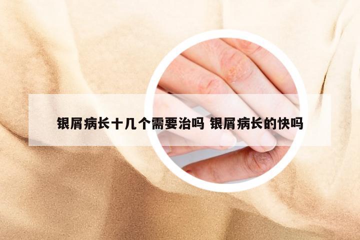 银屑病长十几个需要治吗 银屑病长的快吗