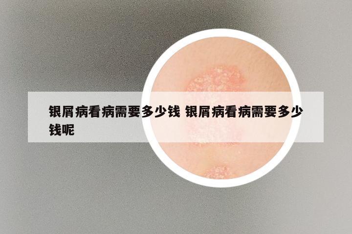 银屑病看病需要多少钱 银屑病看病需要多少钱呢