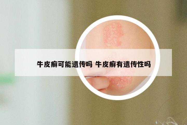 牛皮癣可能遗传吗 牛皮癣有遗传性吗