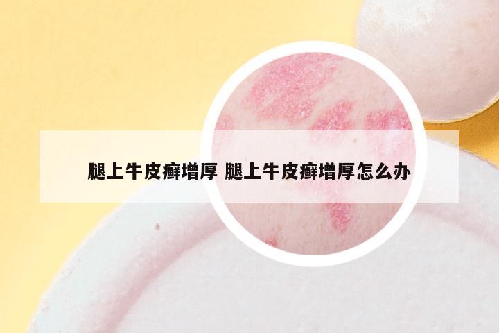 腿上牛皮癣增厚 腿上牛皮癣增厚怎么办