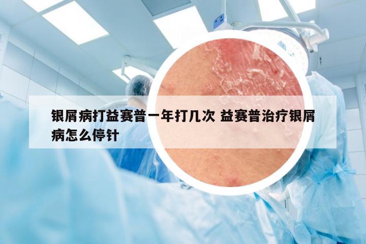 银屑病打益赛普一年打几次 益赛普治疗银屑病怎么停针