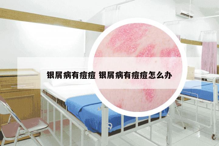 银屑病有痘痘 银屑病有痘痘怎么办