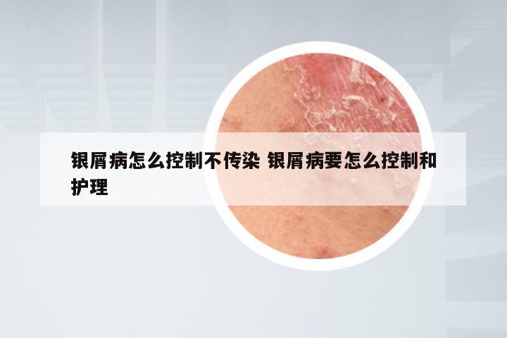 银屑病怎么控制不传染 银屑病要怎么控制和护理
