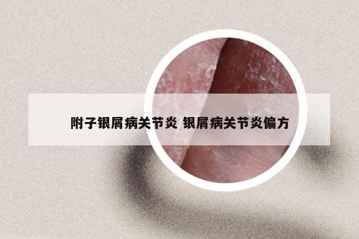 附子银屑病关节炎 银屑病关节炎偏方