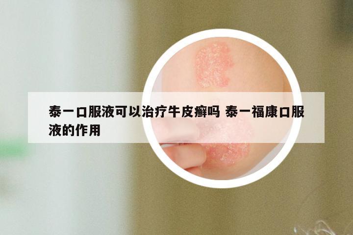 泰一口服液可以治疗牛皮癣吗 泰一福康口服液的作用