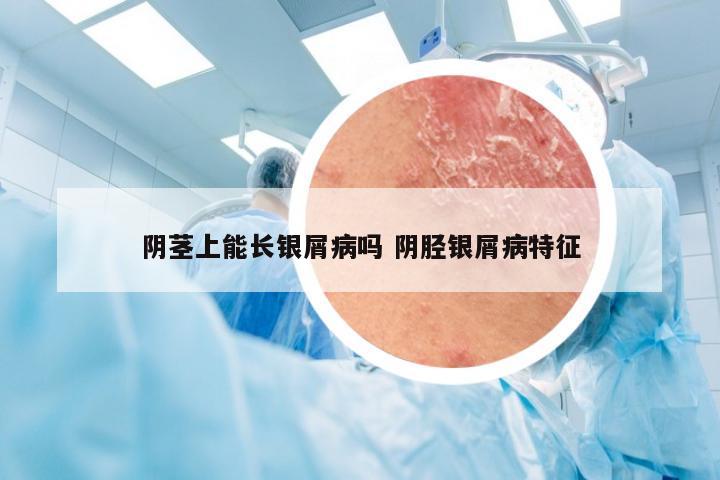 阴茎上能长银屑病吗 阴胫银屑病特征