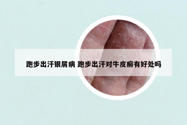 跑步出汗银屑病 跑步出汗对牛皮癣有好处吗