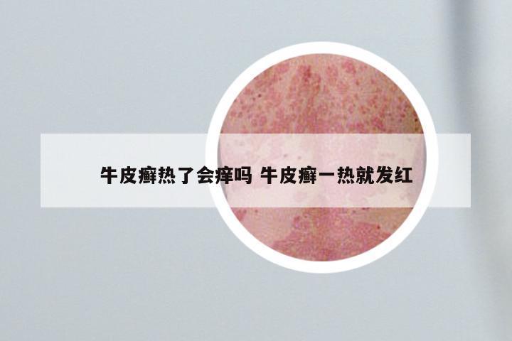 牛皮癣热了会痒吗 牛皮癣一热就发红