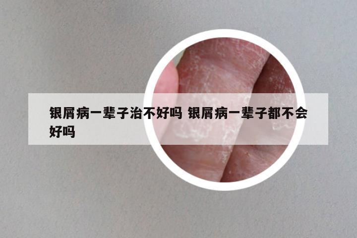 银屑病一辈子治不好吗 银屑病一辈子都不会好吗