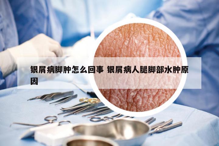 银屑病脚肿怎么回事 银屑病人腿脚部水肿原因