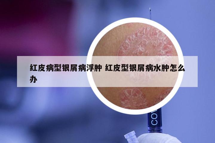 红皮病型银屑病浮肿 红皮型银屑病水肿怎么办