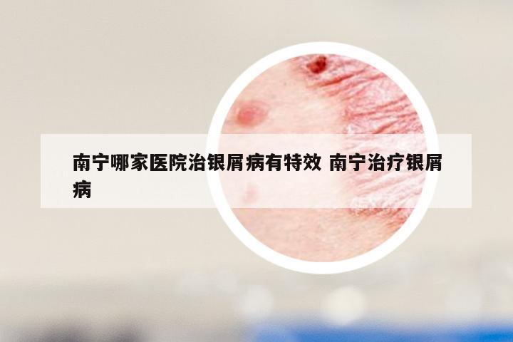 南宁哪家医院治银屑病有特效 南宁治疗银屑病