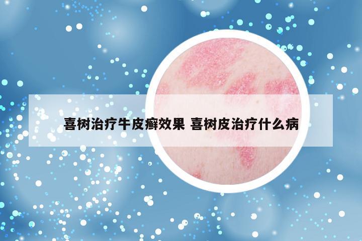 喜树治疗牛皮癣效果 喜树皮治疗什么病