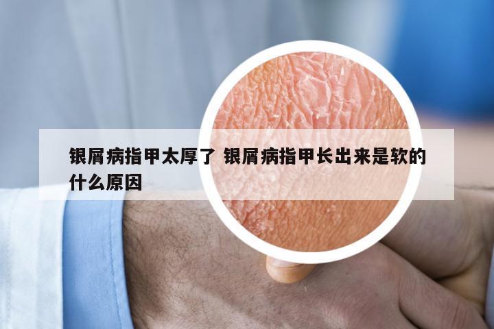 银屑病指甲太厚了 银屑病指甲长出来是软的什么原因