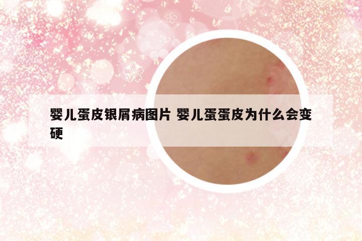 婴儿蛋皮银屑病图片 婴儿蛋蛋皮为什么会变硬