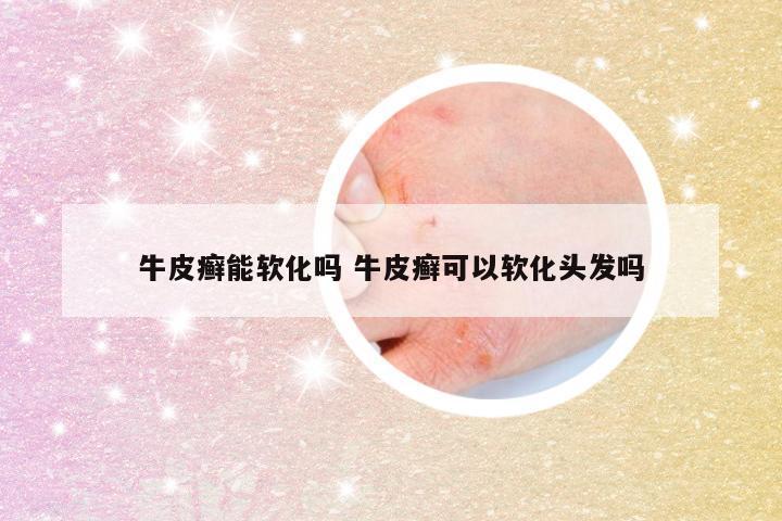 牛皮癣能软化吗 牛皮癣可以软化头发吗