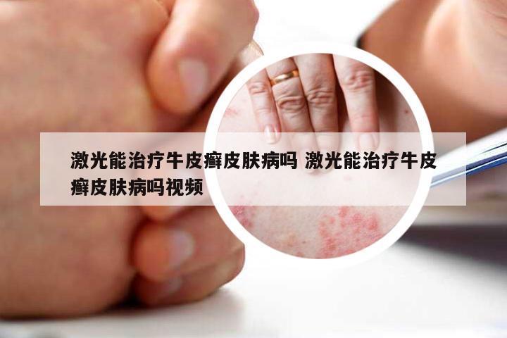 激光能治疗牛皮癣皮肤病吗 激光能治疗牛皮癣皮肤病吗视频