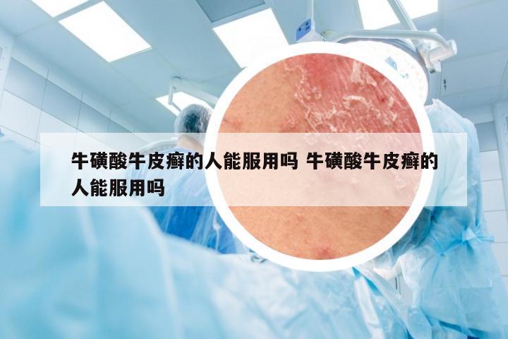 牛磺酸牛皮癣的人能服用吗 牛磺酸牛皮癣的人能服用吗