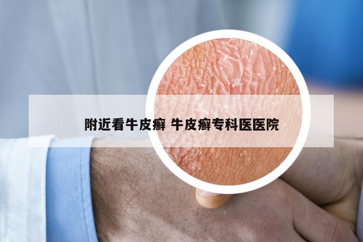附近看牛皮癣 牛皮癣专科医医院