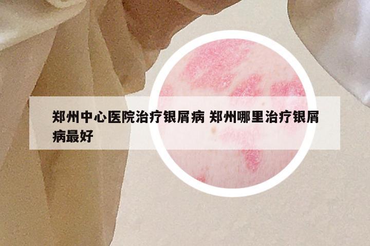 郑州中心医院治疗银屑病 郑州哪里治疗银屑病最好