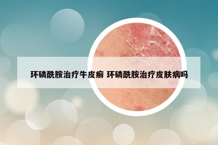 环磷酰胺治疗牛皮癣 环磷酰胺治疗皮肤病吗