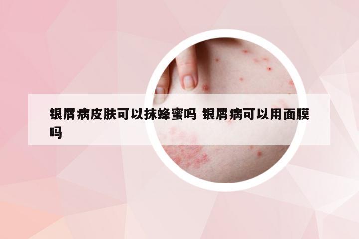 银屑病皮肤可以抹蜂蜜吗 银屑病可以用面膜吗