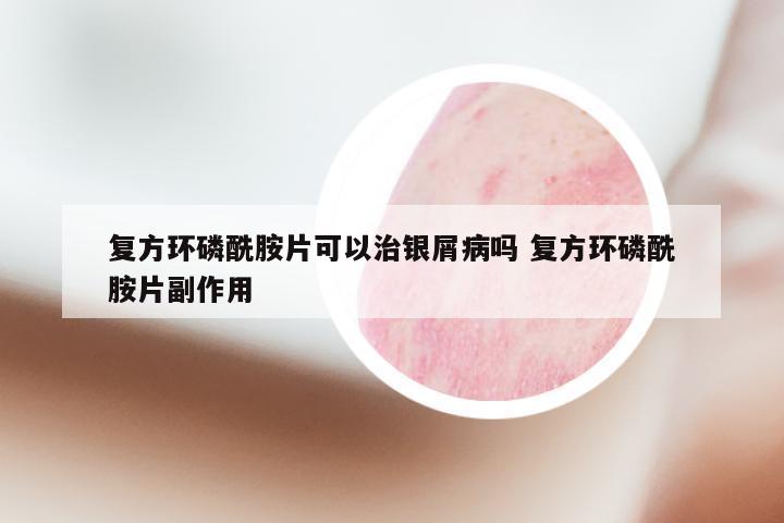 复方环磷酰胺片可以治银屑病吗 复方环磷酰胺片副作用