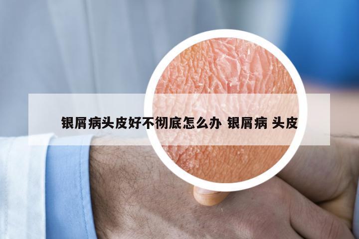 银屑病头皮好不彻底怎么办 银屑病 头皮